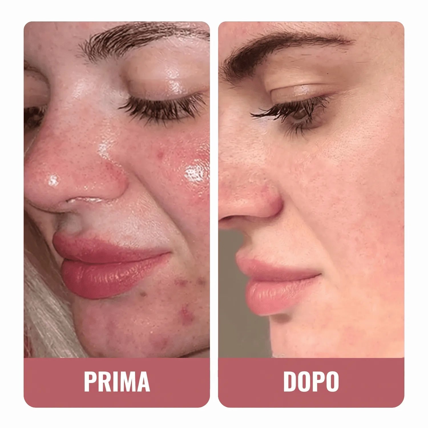 La mia salvezza dopo le eruzioni di acne