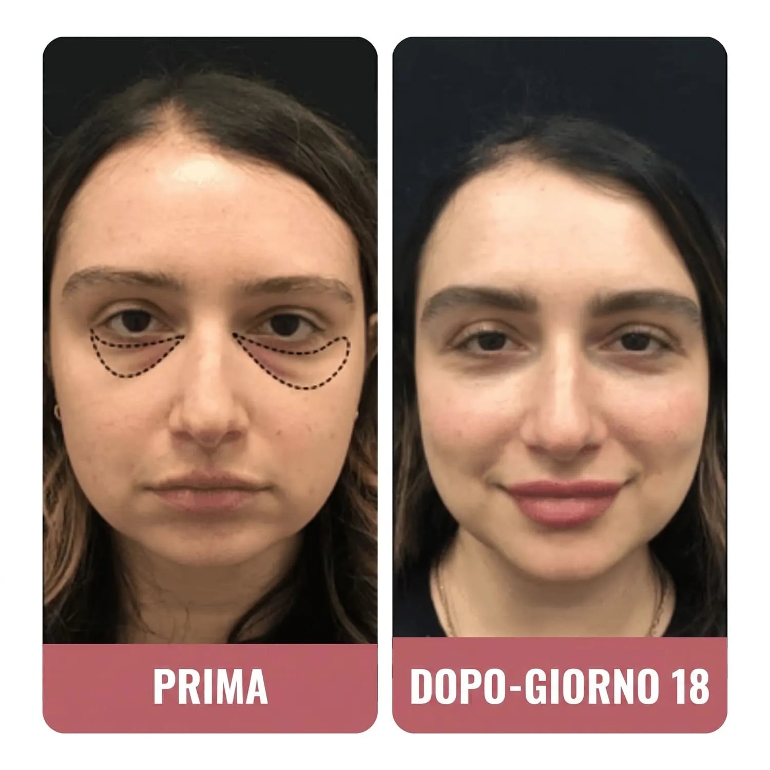 Ho provato molti correttori per le occhiaie.